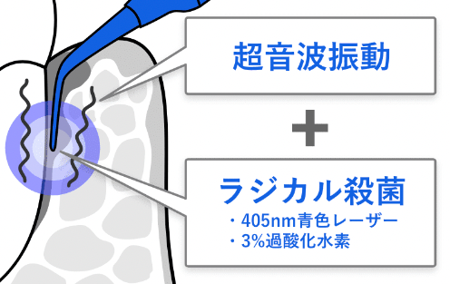超音波振動 + ラジカル殺菌